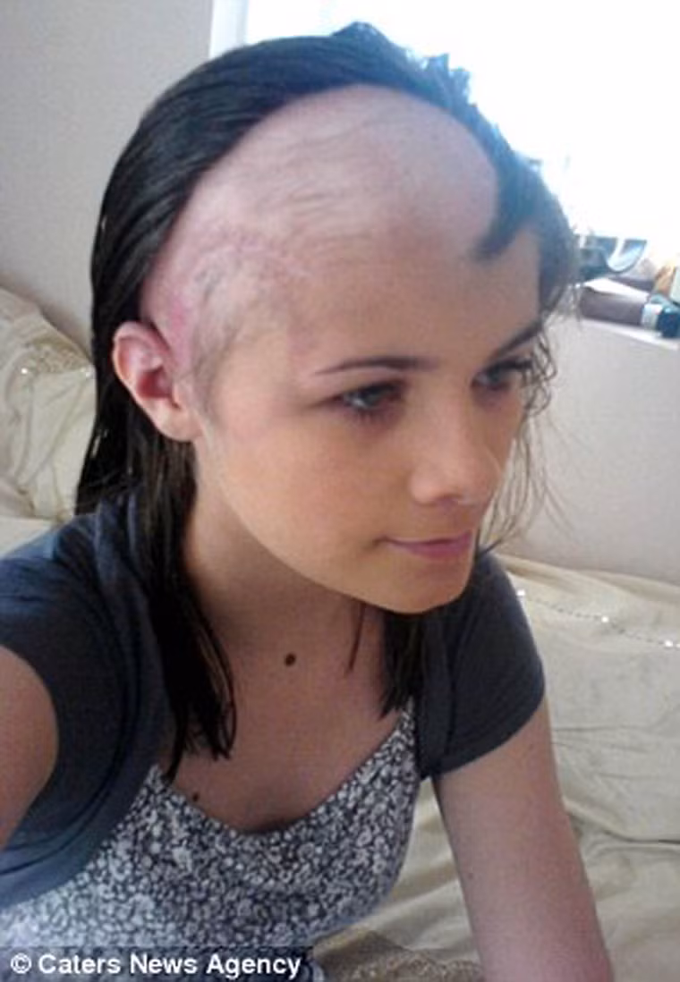 Phải mất tới bốn tháng Hannah mới có thể tự đứng. Cô cũng phải dành nhiều thời gian để có thể giao tiếp trở lại.