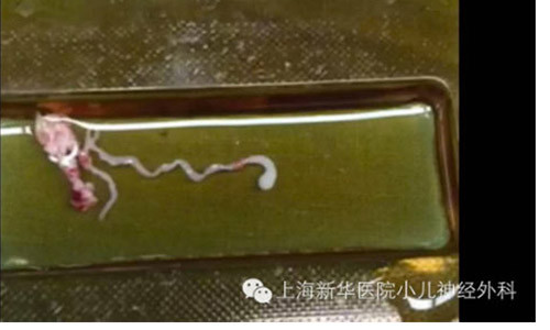 Con sán dài 8cm ăn sâu vào não, khiến cậu bé lên cơn co giật dữ dội.