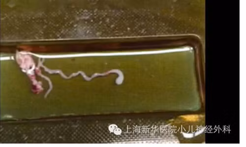 Con sán dài 8cm ăn sâu vào não, khiến cậu bé lên cơn co giật dữ dội.