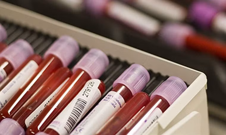 Thử nghiệm PSA là xét nghiệm ung thư. Thực tế, PSA là xét nghiệm đo mức kháng nguyên tiền liệt tuyến. PSA được sản xuất bởi tiền liệt tuyến nhằm đối phó với các vấn đề sức khỏe ở khu vực này như viêm, nhiễm trùng, phì đại tiền liệt tuyến. Nó chỉ là bước đầu tiên trong quá trình chẩn đoán ung thư mà thôi.