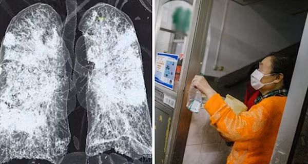 Trieu chung mac di chung phoi sau khi am tinh