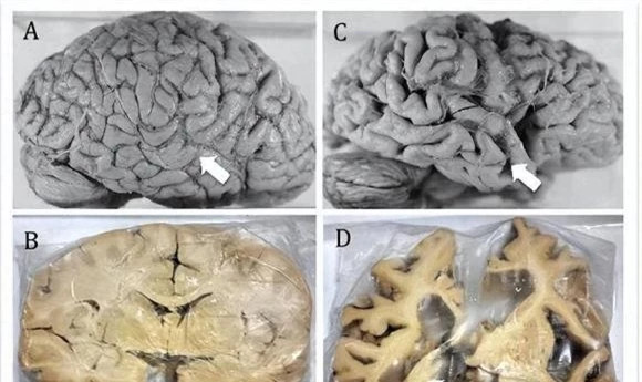 So sánh sự phân bổ não giữa bệnh nhân não bình thường và bệnh Alzheimer: Bệnh Alzheimer là một bệnh thoái hóa thần kinh tiến triển gây tổn thương não không thể phục hồi. Bệnh chủ yếu ảnh hưởng đến các vùng não liên quan đến trí nhớ, suy nghĩ và kiểm soát hành vi. Khi bệnh tiến triển, các tế bào thần kinh dần chết đi và xấu đi khiến tế bào não co lại.