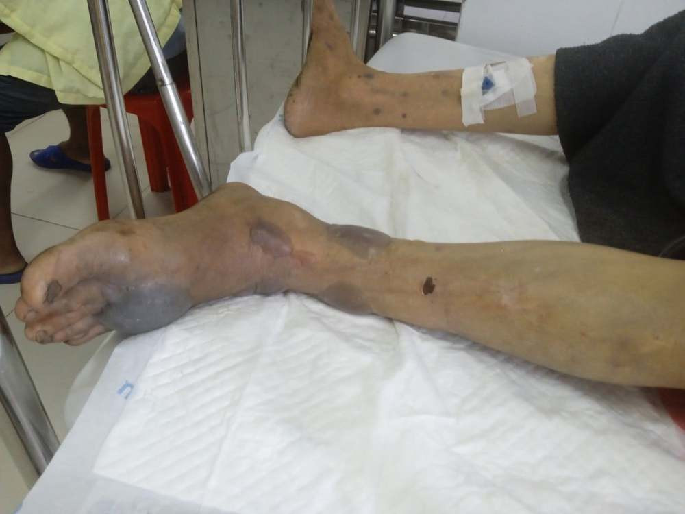Người này lập tức được đưa vào bênh viện Chợ Rẫy TP.HCM với vết cắn sưng to và có bỏng phồng nước. Dù không còn nguy hiểm tính mạng nhưng ông đã phải thanh toán tiền viện phí lên tới 100 triệu đồng.