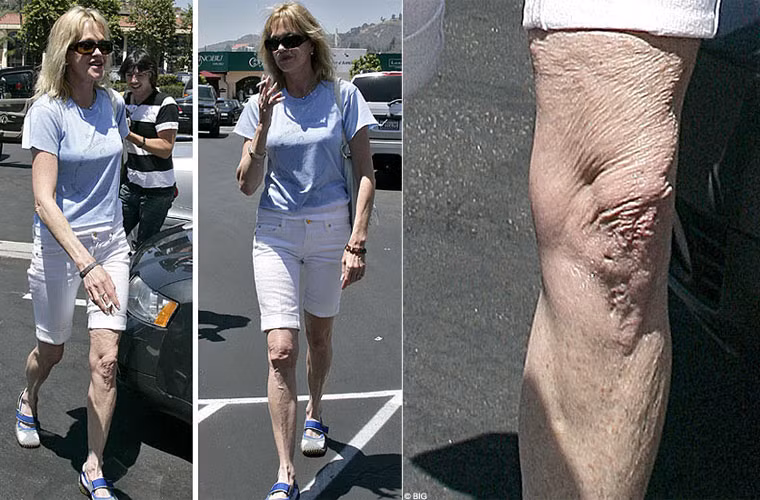 Nữ diễn viên Melanie Griffith từng có thời kỳ bị gày hẳn đi và hậu quả là đôi chân nhăn nhúm đến khó tin.