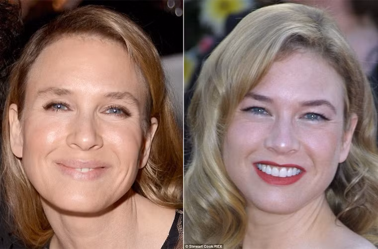 Bác sĩ Alex Karidis ở Bệnh viên Karaidis, London khẳng định Renee đã phẫu thuật thẩm mỹ nâng mí mắt trên bởi khoảng cách giữa lông mày và mắt của cô hiện tại nhỏ hơn so với trước.