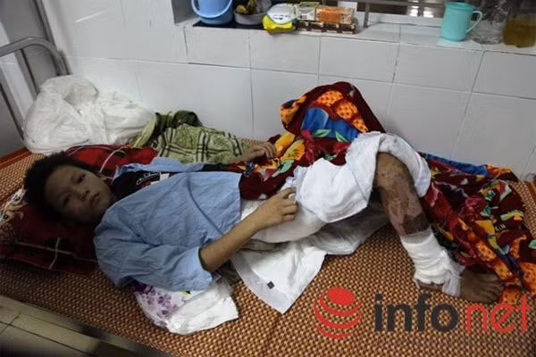 Cháu Thành đang điều trị tại khoa chấn thương, Bệnh viện đa khoa Hà Tĩnh trong tình trạng bỏng nặng trên 40% và rất cần nhiều sự giúp đỡ của các nhà hảo tâm.