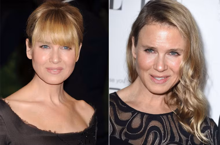 Renee năm 2013 (trái) và 2014 có sự khác biệt rất nhiều trên khuôn mặt và trông như hai người khác nhau. Nguyên nhân sự thay đổi này được cho là ngôi sao Hollywood đã phẫu thuật thẩm mỹ khuôn mặt như tiêm Botox, dùng liệu pháp Thermage cho vùng mặt, nâng mí mắt trên.