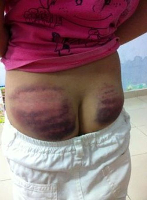 Toàn bộ phần mông cháu V. bầm tím vì đòn roi của thầy giáo