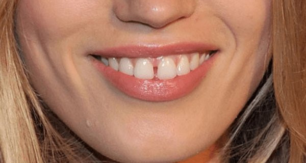 Nhìn tướng răng đoán ngay số phận giàu có hay nghèo hèn Nhin tuong rang doan ngay so phan giau co hay ngheo hen