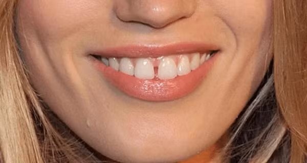 Nhìn tướng răng đoán ngay số phận giàu có hay nghèo hèn Nhin tuong rang doan ngay so phan giau co hay ngheo hen