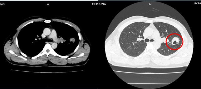 Co 2 dau hieu nay di kham, nguoi dan ong phat hien ung thu