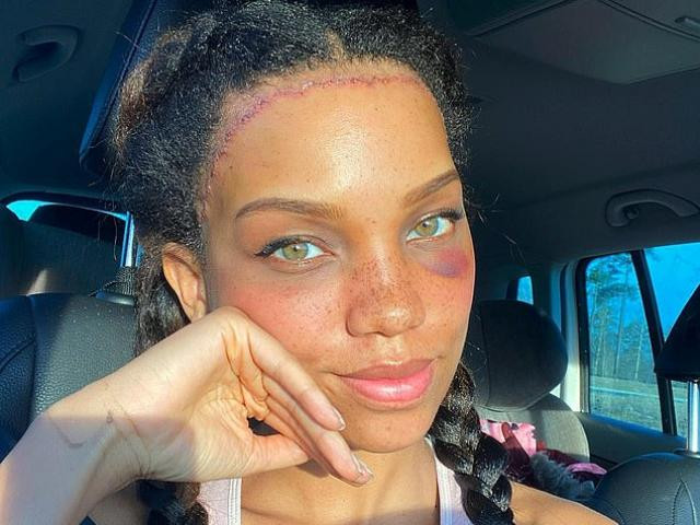 Co gai chi tien khung de phau thuat che giau vang tran “san bay”