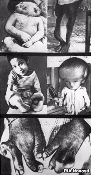 Hình ảnh hết sức chua xót cho thấy hậu quả khủng khiếp của chất hóa học gây ra đối với trẻ em Việt Nam.