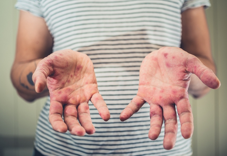 Nguoi lon co the mac benh tay chan mieng khong?