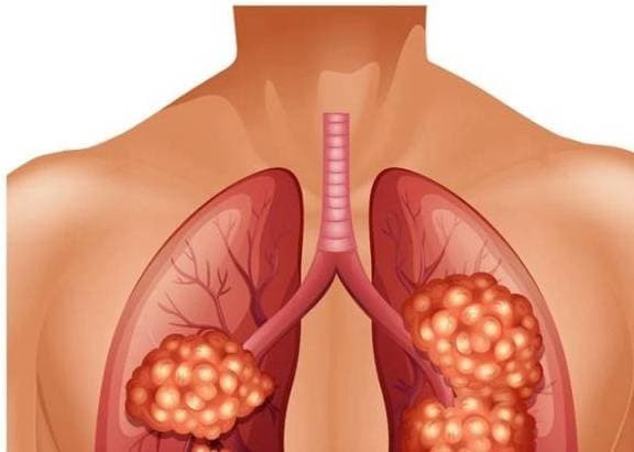 O giai doan dau ung thu phoi, “den do” sang o 4 vi tri nay