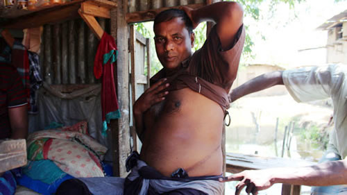 Mohammad Hossen bị cắt một quả thận và không có khả năng làm việc nặng.