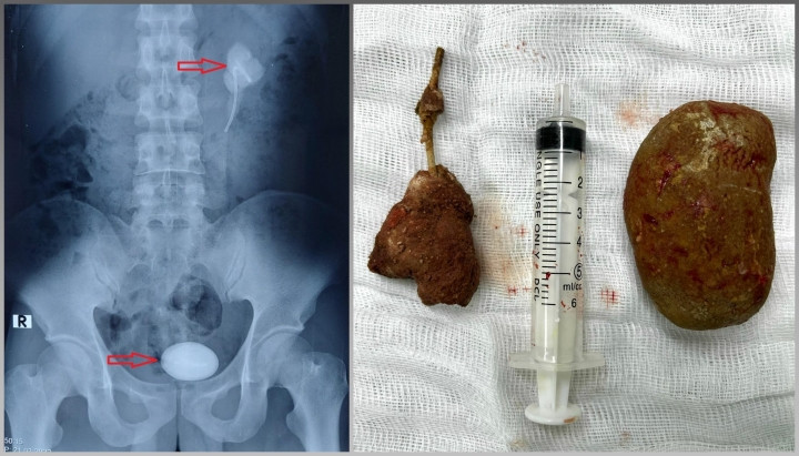 Vien soi to hon qua trung ga trong bang quang cua thanh nien 27 tuoi