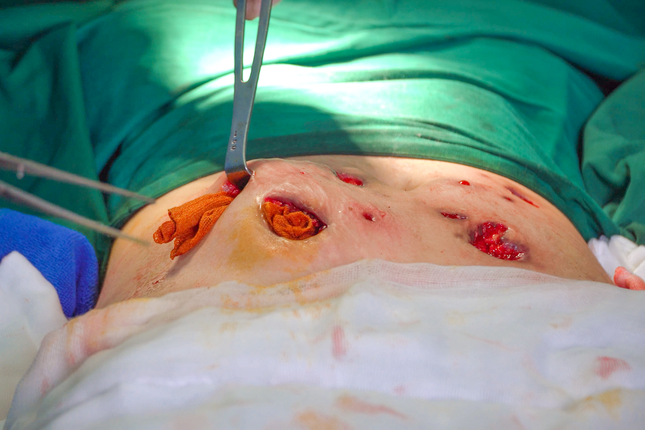 Tu tiem thuoc tan mo, bung benh nhan hoai tu trao mu nhu 