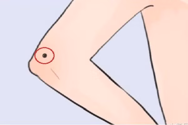 Du nam hay nu, so huu 3 not ruoi nay la tuong vuong loc-Hinh-2