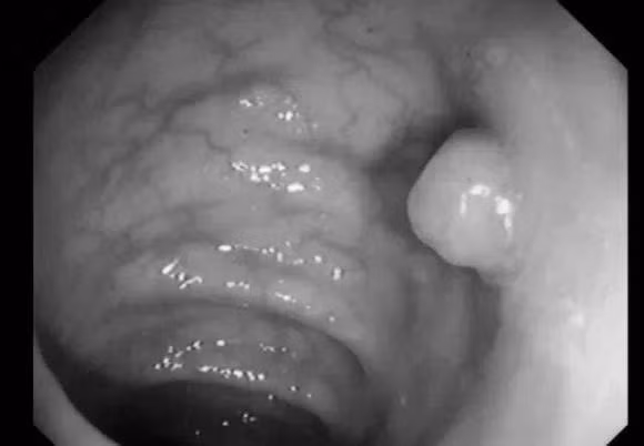 Polyp duong ruot co phat trien thanh ung thu ruot ket?-Hinh-4