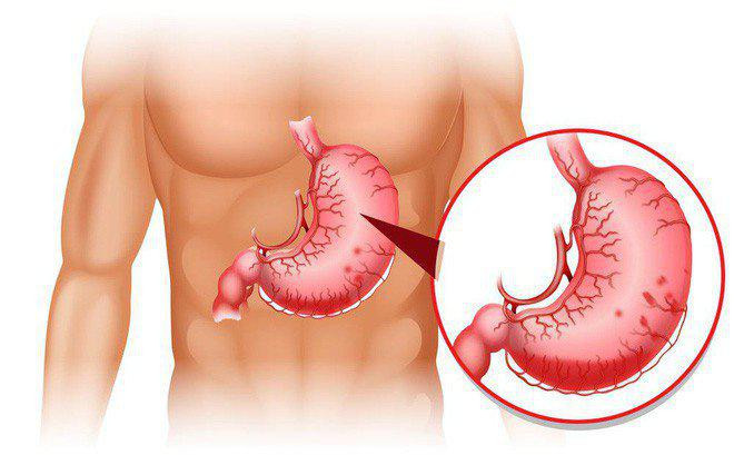 Các nhóm thực phẩm tàn phá dạ dày Cac nhom thuc pham tan pha da day