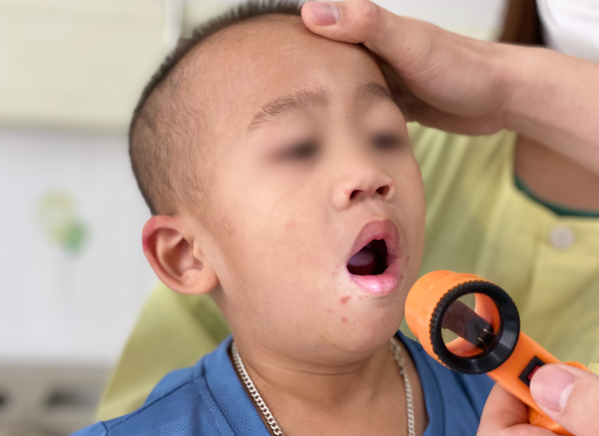 Dau hieu tre mac tay chan mieng can nhap vien