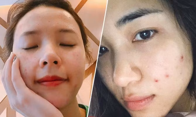 Ninh Duong Lan Ngoc tra gia vi thoi quen cuc xau khi bi mun-Hinh-3