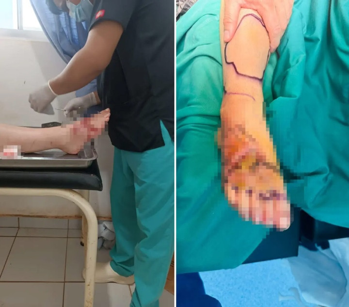 Suyt mat mang vi bi ca heo can-Hinh-2