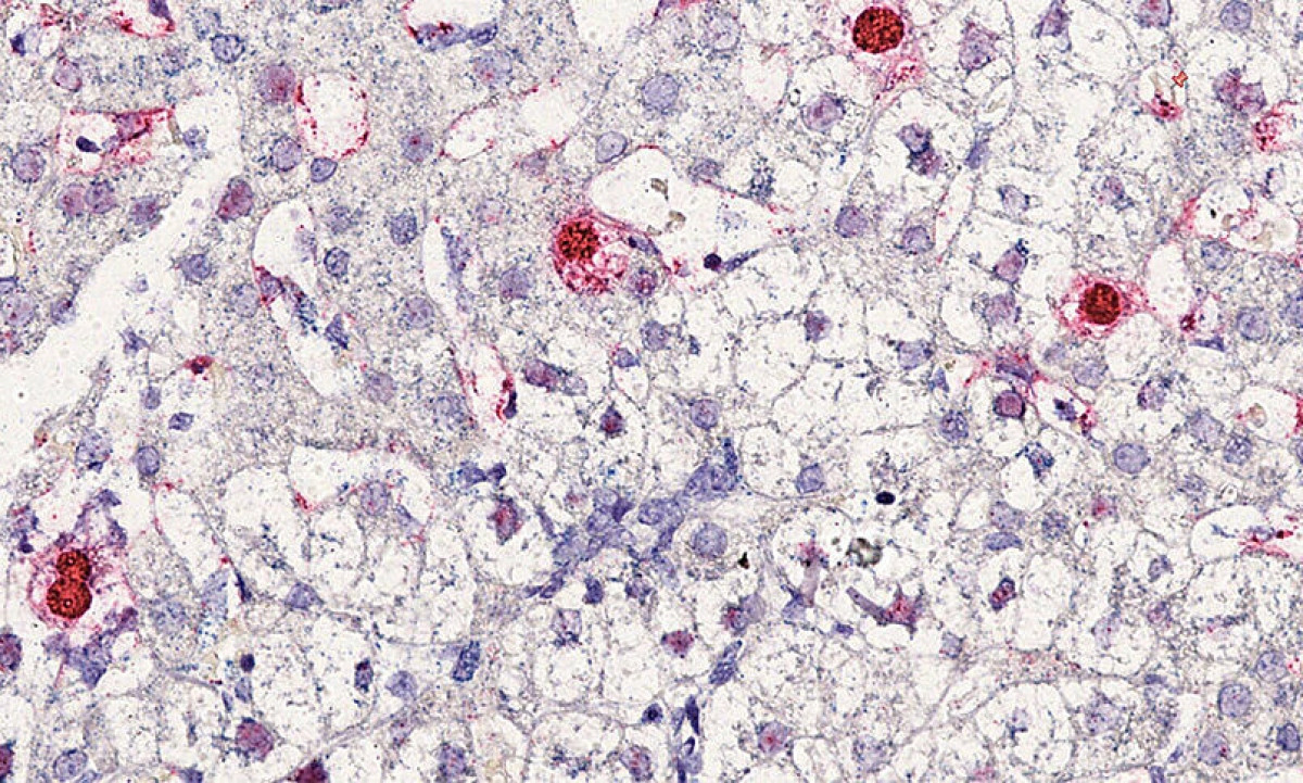 Phát hiện virus mới gây bệnh viêm gan ở người Phat hien virus moi gay benh viem gan o nguoi