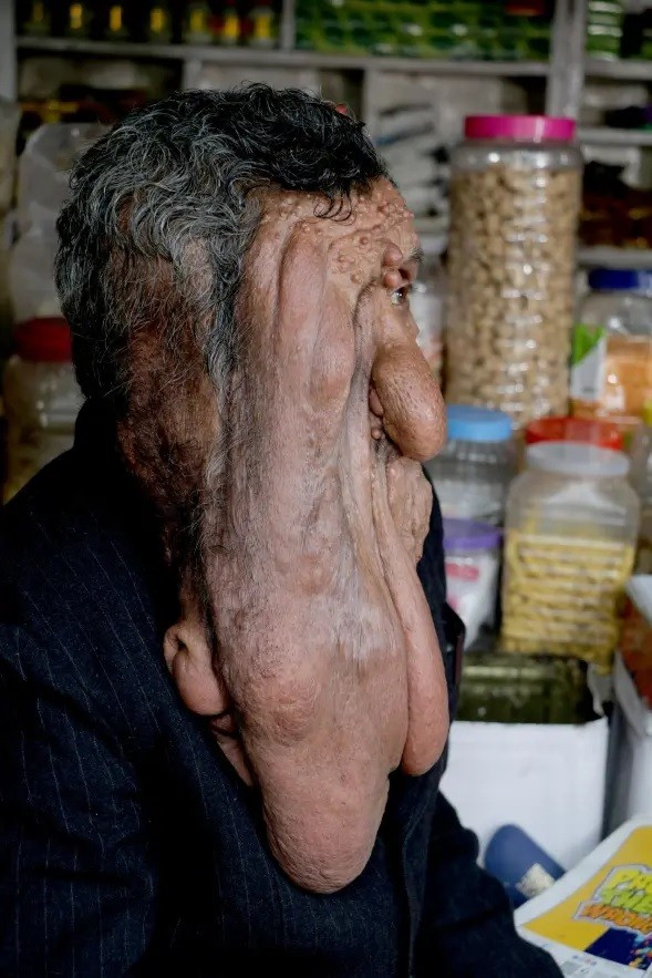 Nguoi dan ong co bo mat chay xe la ky, can benh hiem gap-Hinh-2