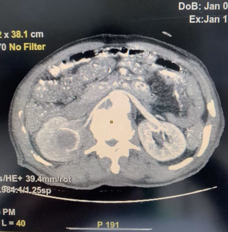 Dấu hiệu bệnh mờ nhạt, cô gái 28 tuổi nhận kết quả ung thư Dau hieu benh mo nhat, co gai 28 tuoi nhan ket qua ung thu