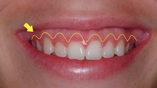 Cuoi ho loi la suong hay kho, co anh huong den tinh duyen?