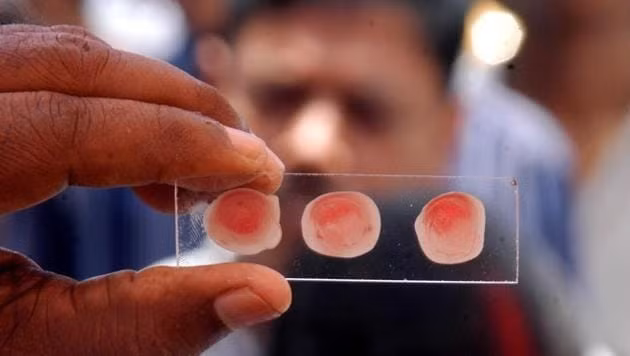 Nhom mau co nguy co mac benh tim cao nhat