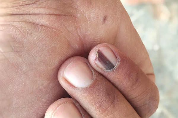 Nhìn móng tay chẩn đoán bệnh - Hình 2 Nhin mong tay chan doan benh-Hinh-2