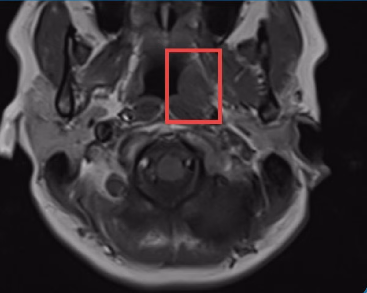 Can trong voi loai ung thu nguy hiem nhung co trieu chung mo ho