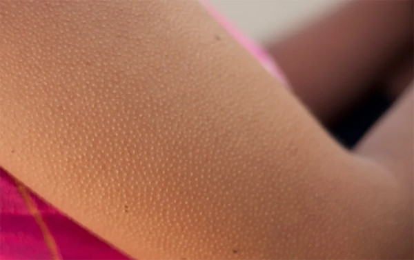 Lý do bạn nổi da gà khi lạnh hoặc sợ Ly do ban noi da ga khi lanh hoac so