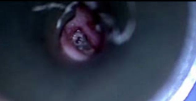  Và đây là hình ảnh ấu trùng ăn thịt đang ngọ nguậy trong tai mà họ thu được. 