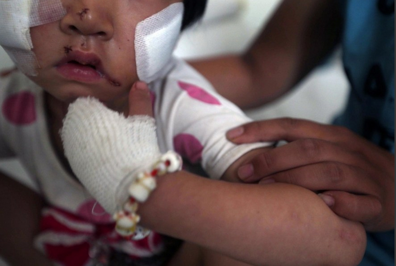 Cha mẹ bé hy vọng các bác sĩ có thể giữ lại khuôn mặt ngây thơ của một đứa trẻ, nhưng các chi phí thẩm mỹ lên tới 200.000 USD, và họ không đủ điều kiện để thực hiện.