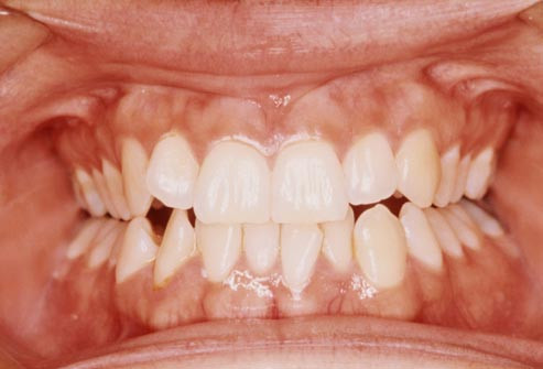 Nghiến răng: Tật nghiến răng có thể dẫn đến một loạt các vấn đề về răng bao gồm hao mòn răng, sứt mẻ, nứt, gãy răng và lung lay. Nó cũng có thể gây đau ở các khớp xương hàm, nhức đầu và đau răng nghiêm trọng.