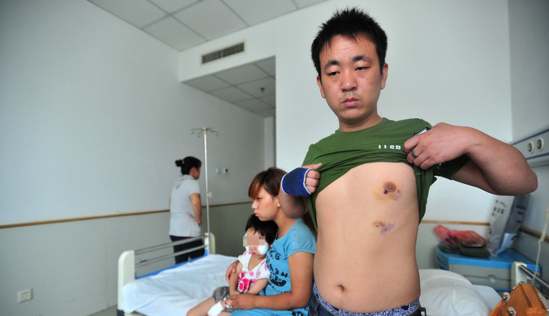 Nhiều vết răng, cào xước con chó tấn công trên vùng bụng, ngực người cha.