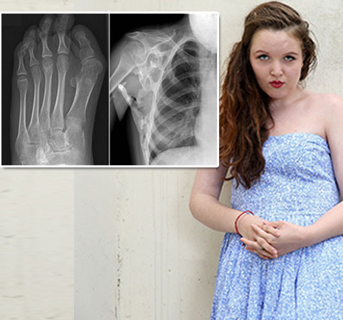 Hội chứng FOP chỉ ảnh hưởng đến 45 người ở Anh.