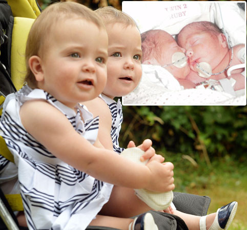 Dù cặp song sinh này sẽ cần phải thường xuyên kiểm tra sức khỏe trong suốt thời thơ ấu, nhưng các bác sĩ cho rằng họ đang tiến bộ rất nhanh.