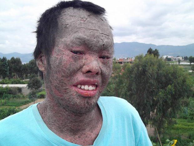 Cậu bé mồ côi Minh Anh cũng mắc căn bệnh này.