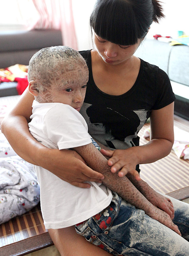 Hiện tại, chưa có cách chữa cụ thể nào đối với căn bệnh này, các bác sĩ chỉ đưa ra lời khuyên bệnh nhân nên sử dụng các loại kem dưỡng ẩm để làm giảm các triệu chứng đau rát.