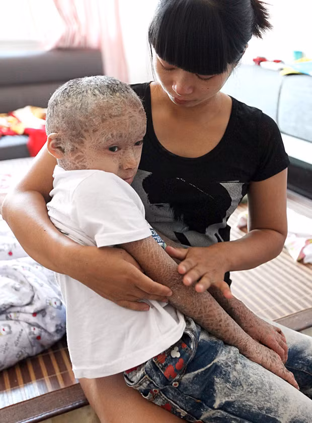 Hiện tại, chưa có cách chữa cụ thể nào đối với căn bệnh này, các bác sĩ chỉ đưa ra lời khuyên bệnh nhân nên sử dụng các loại kem dưỡng ẩm để làm giảm các triệu chứng đau rát.