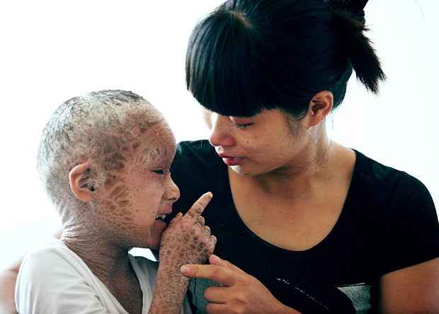 Thậm chí bé không thể ngủ được bởi hiện tượng ngứa rát và nóng khắp người.