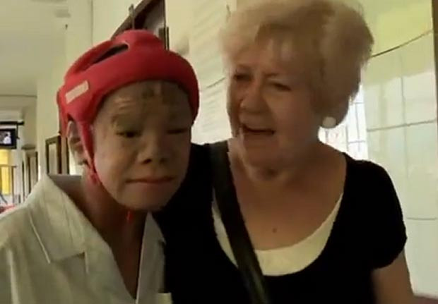 Năm ngoái, Kênh phim tài liệu Channel 5 cũng đã đưa tin một cậu bé người Việt Nam với căn bệnh tương tự.