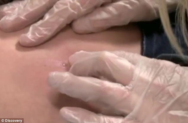 Vết thương trên da nơi lũ dòi ký sinh.