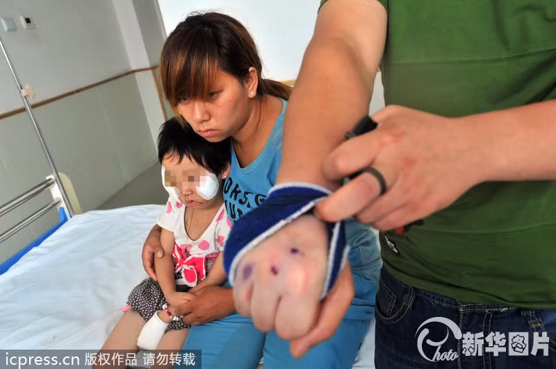 Những vết thương trên tay người cha khi cố gắng ngăn con chó hung bạo tấn công con gái.