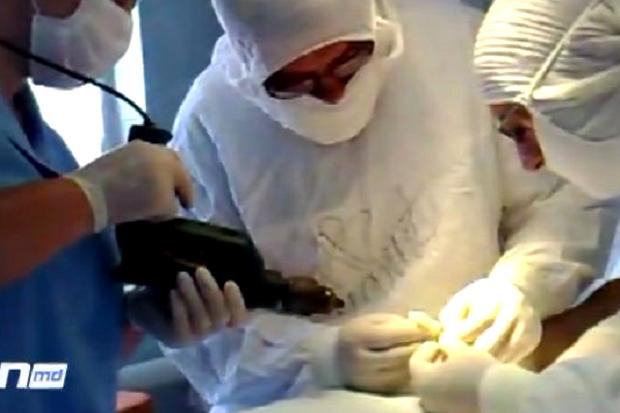 Hình ảnh chụp lại video bác sĩ dùng khoan điện để phẫu thuật cho bệnh nhân.